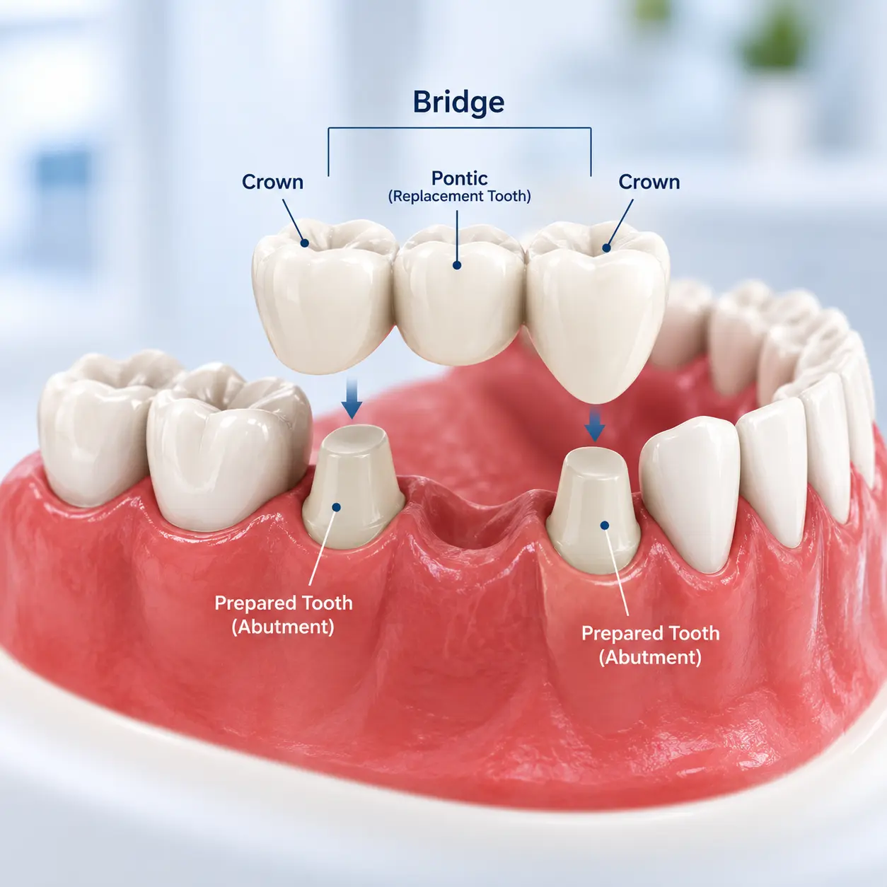 Crowns and Bridges